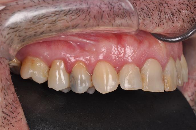 caso-clinico-4-antes