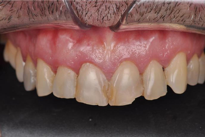 caso-clinico-6-antes