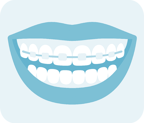 Aparelho Fixo Estético (Cerâmico)